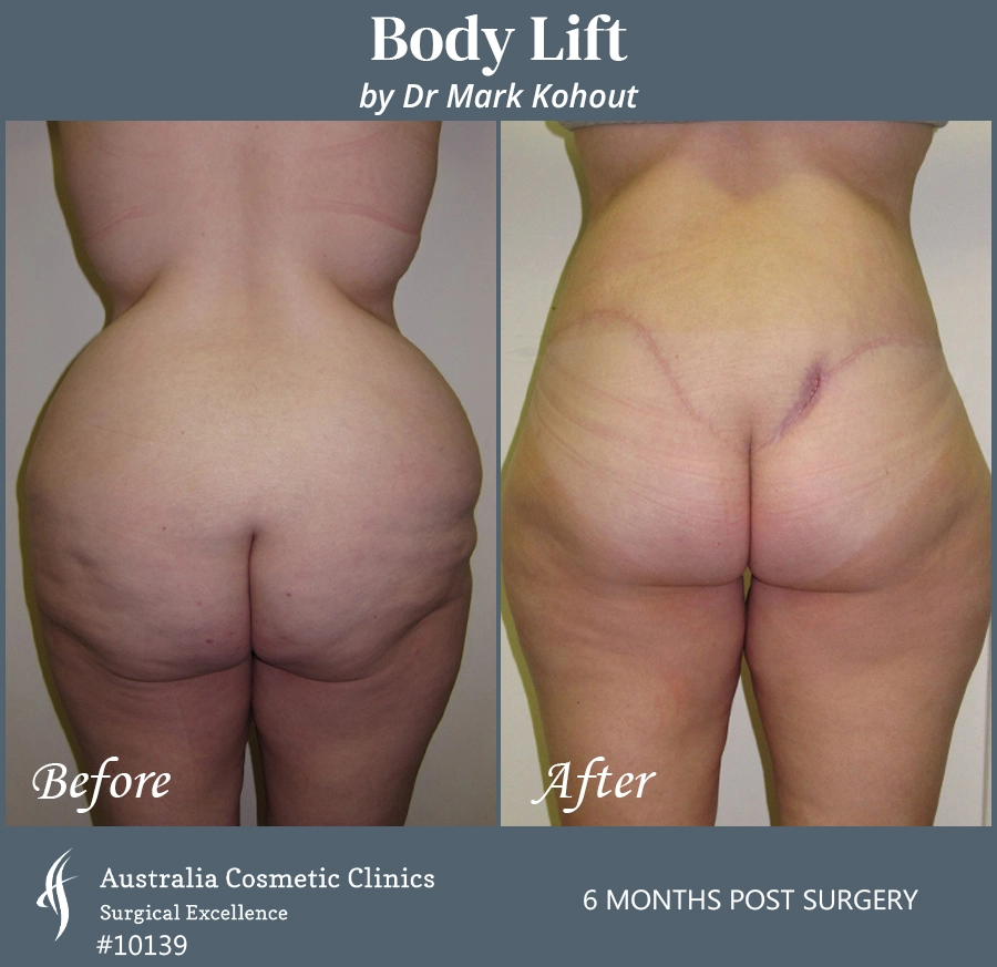 Body Lift Patient 10139 Back