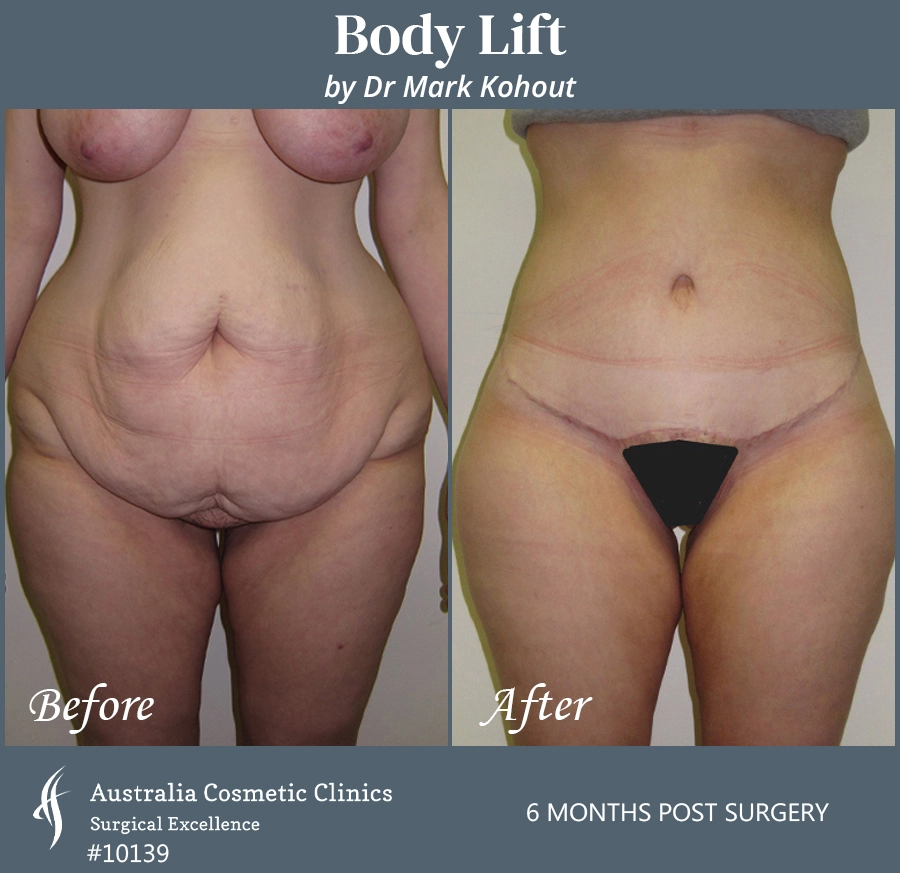 Body Lift Patient 10139 Front