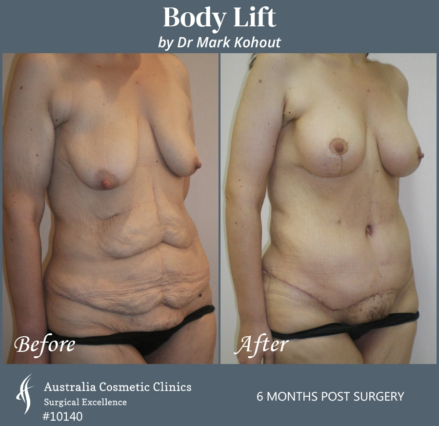 Body Lift Patient 10140 45