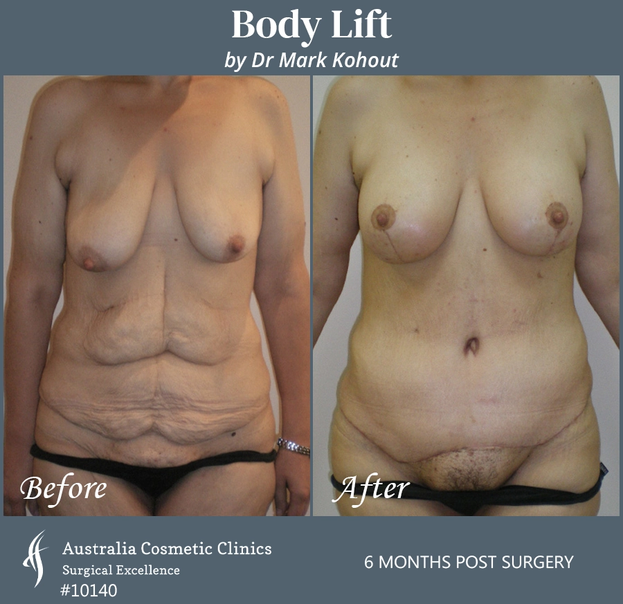 Body Lift Patient 10140 Front