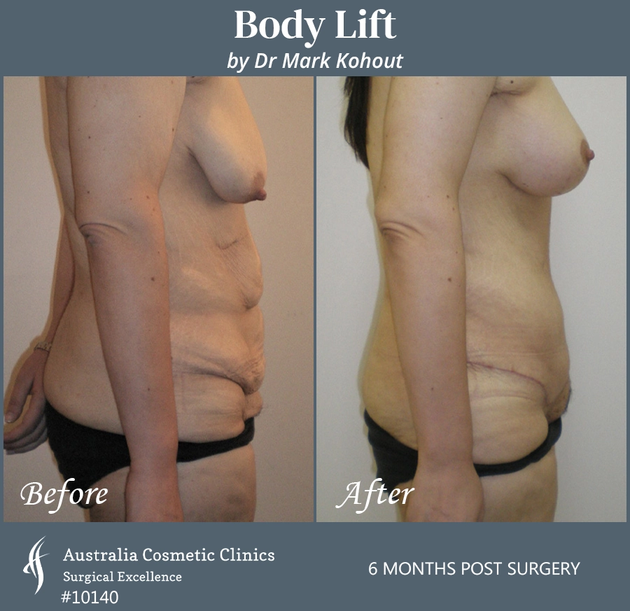 Body Lift Patient 10140 Side