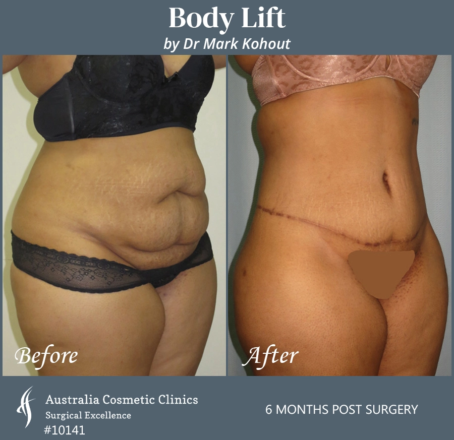 Body Lift Patient 10141 45