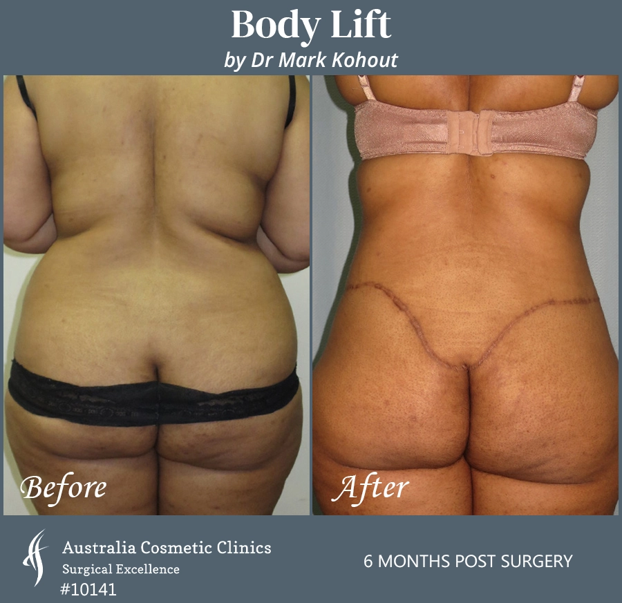 Body Lift Patient 10141 Back