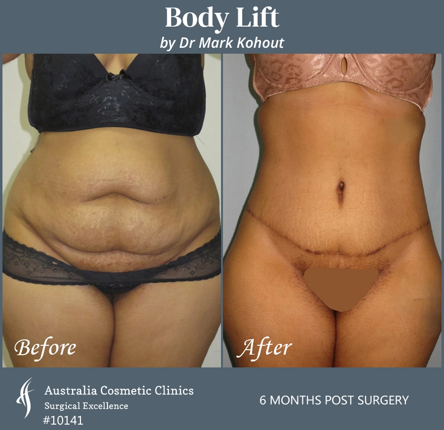 Body Lift Patient 10141 Front