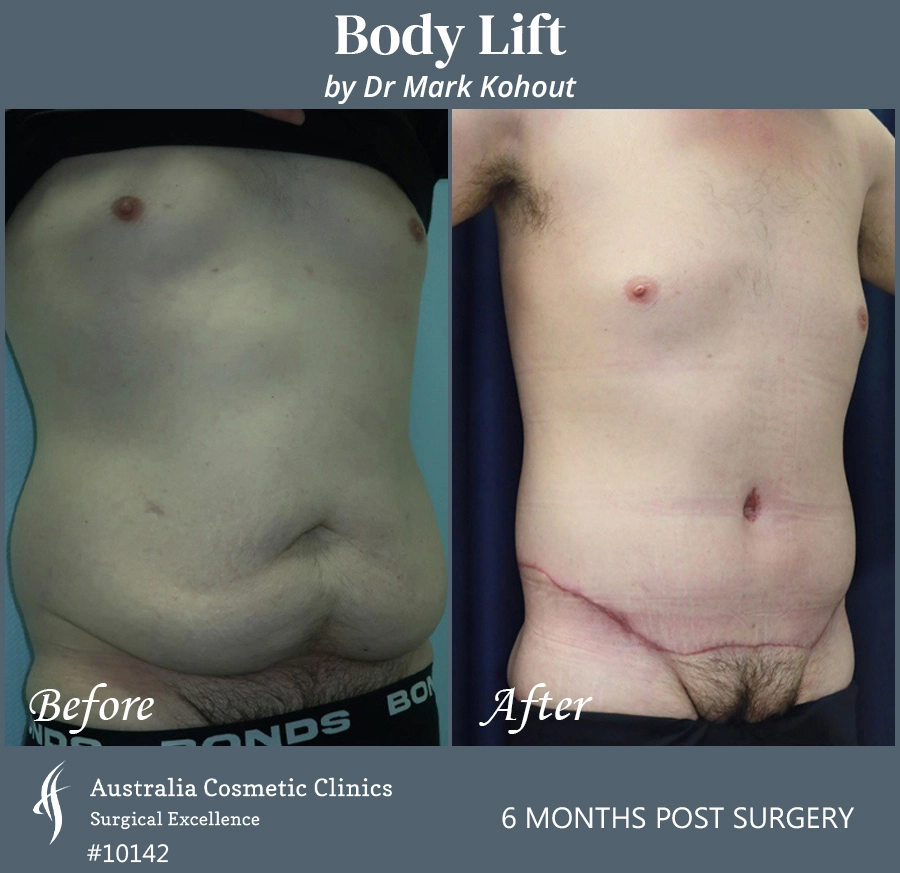 Body Lift Patient 10142 45