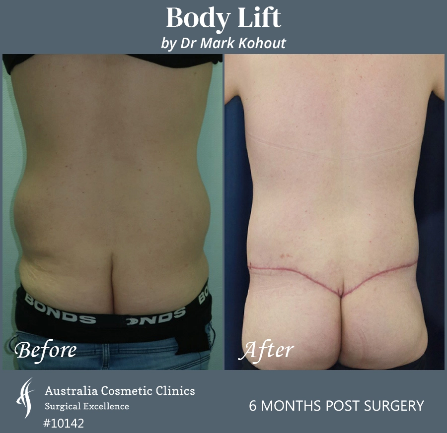 Body Lift Patient 10142 Back