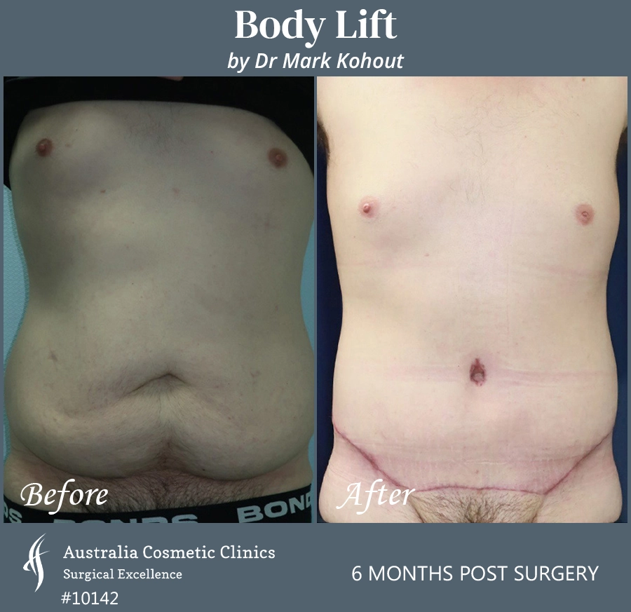 Body Lift Patient 10142 Front