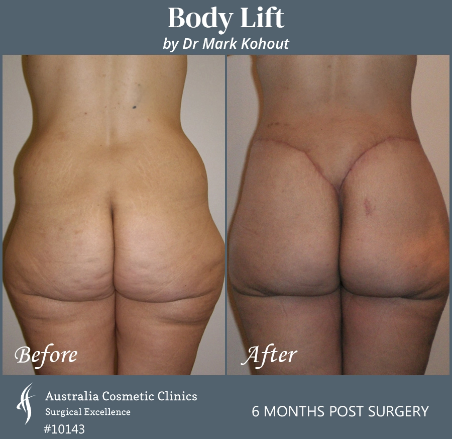 Body Lift Patient 10143 Back