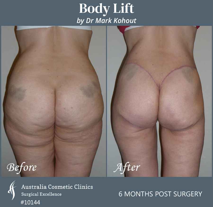 Body Lift Patient 10144 Back