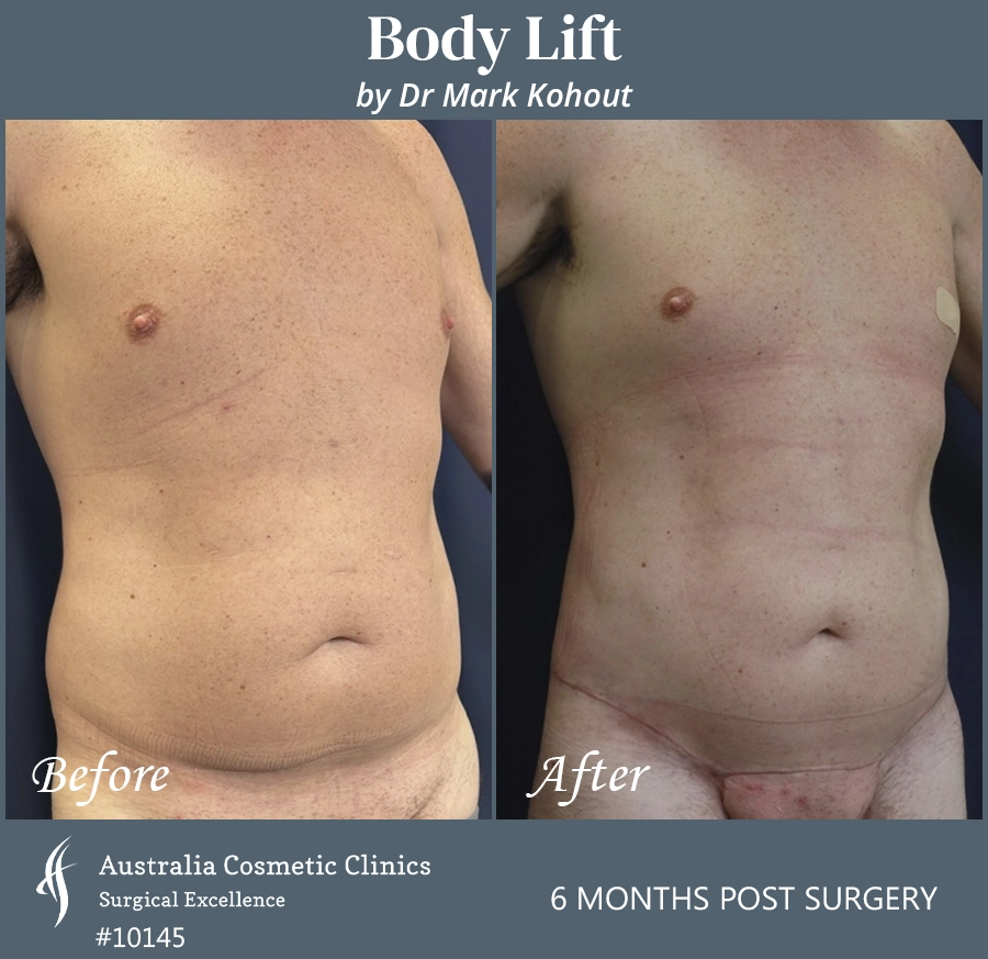 Body Lift Patient 10145 45