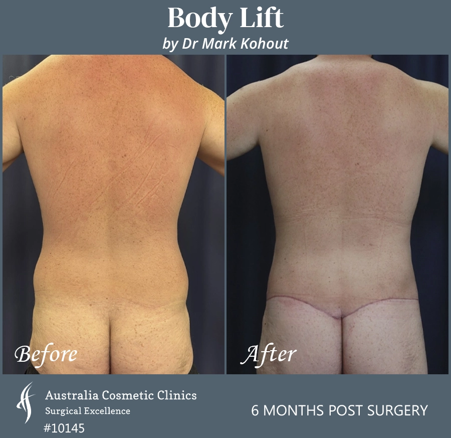 Body Lift Patient 10145 Back