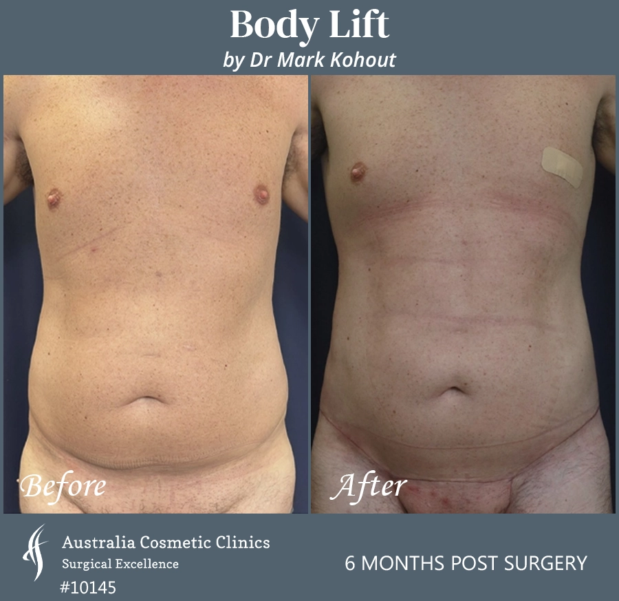 Body Lift Patient 10145 Front