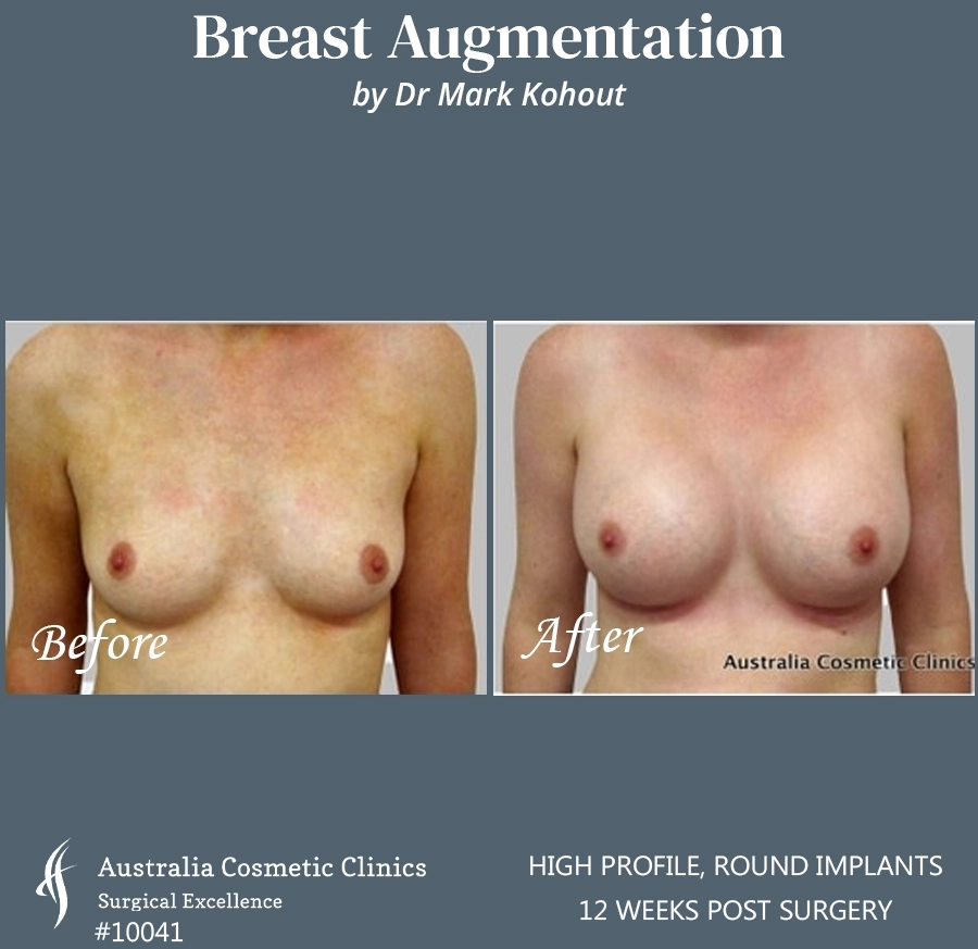 Breast Augmentation Patient 10041 FRONT