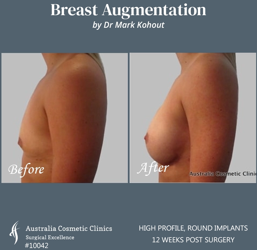 Breast Augmentation Patient 10042 SIDE
