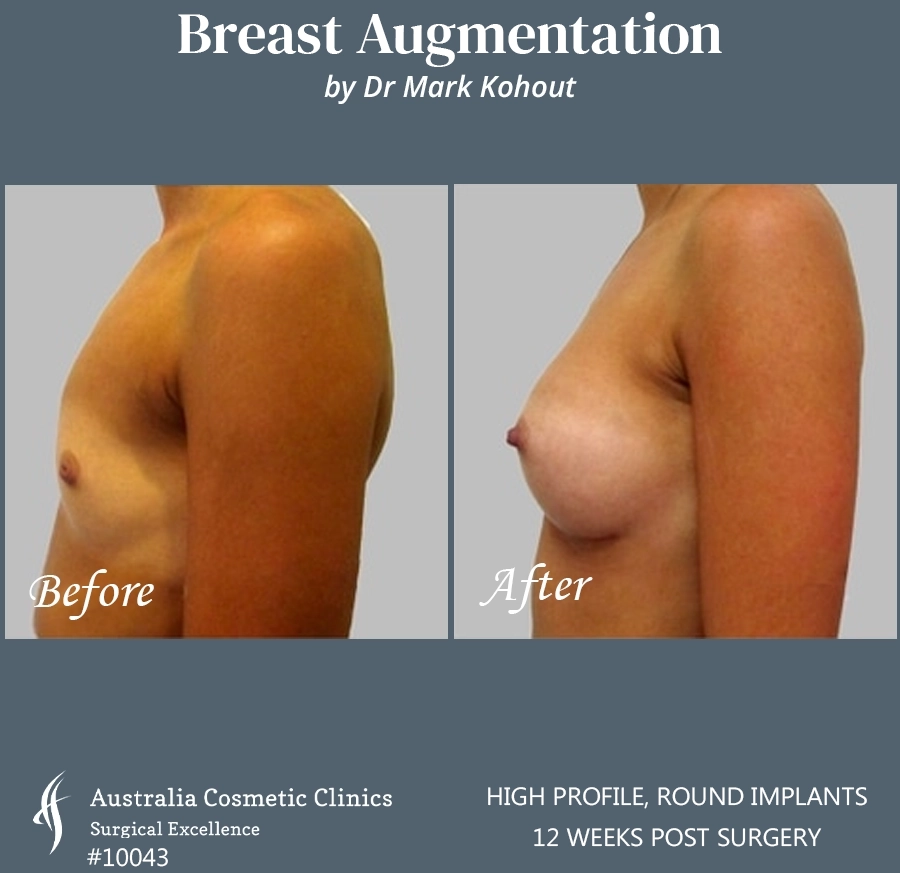 Breast Augmentation Patient 10043 RIGHT SIDE