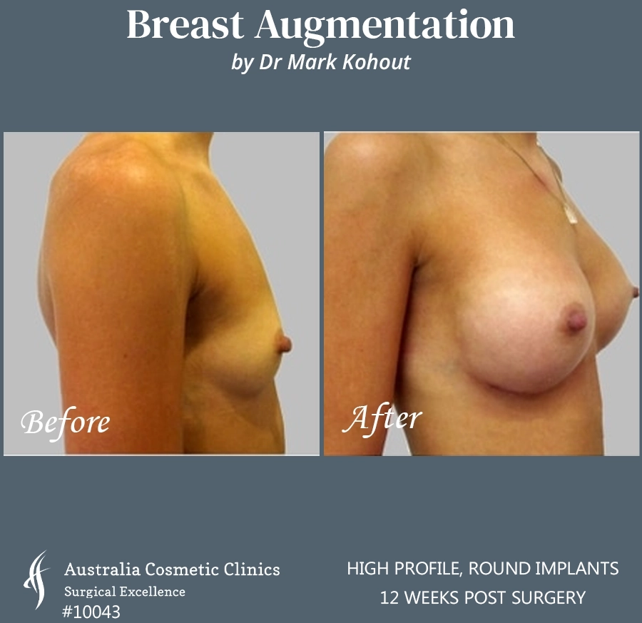 Breast Augmentation Patient 10043 SIDE