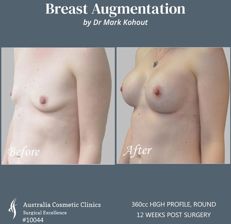 Breast Augmentation Patient 10044 45