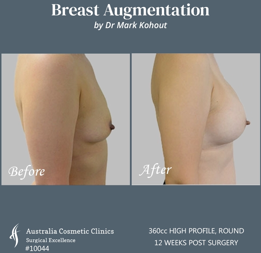 Breast Augmentation Patient 10044 SIDE