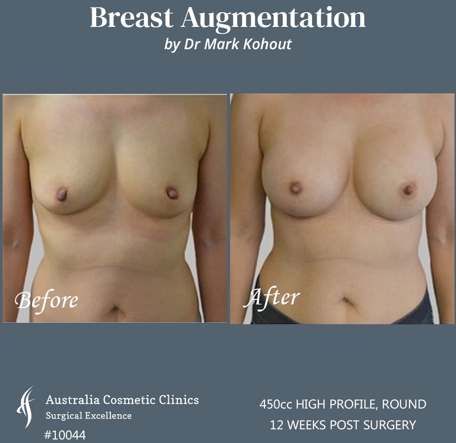 Breast Augmentation Patient 10045 FRONT