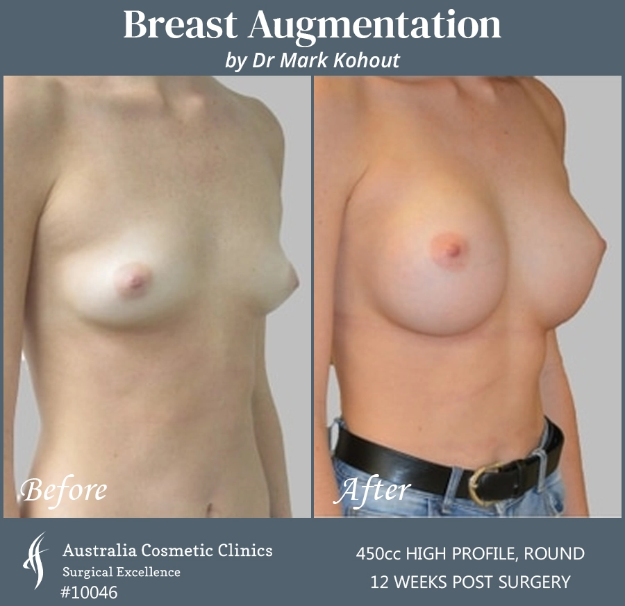 Breast Augmentation Patient 10046 45