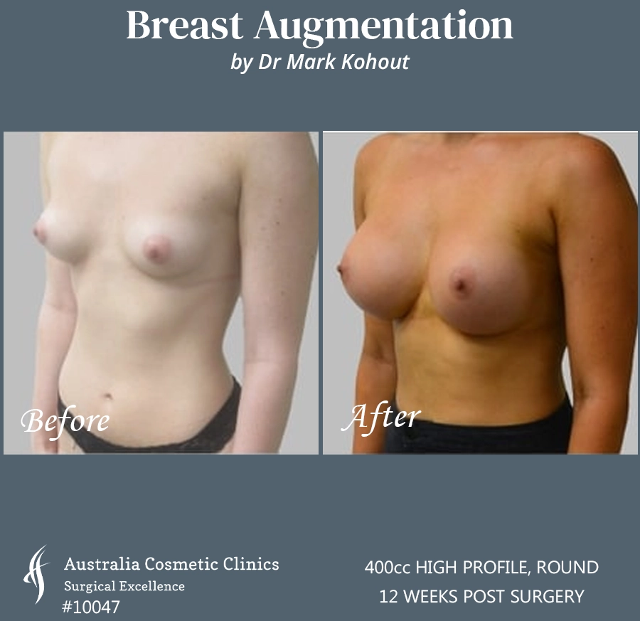 Breast Augmentation Patient 10047 45