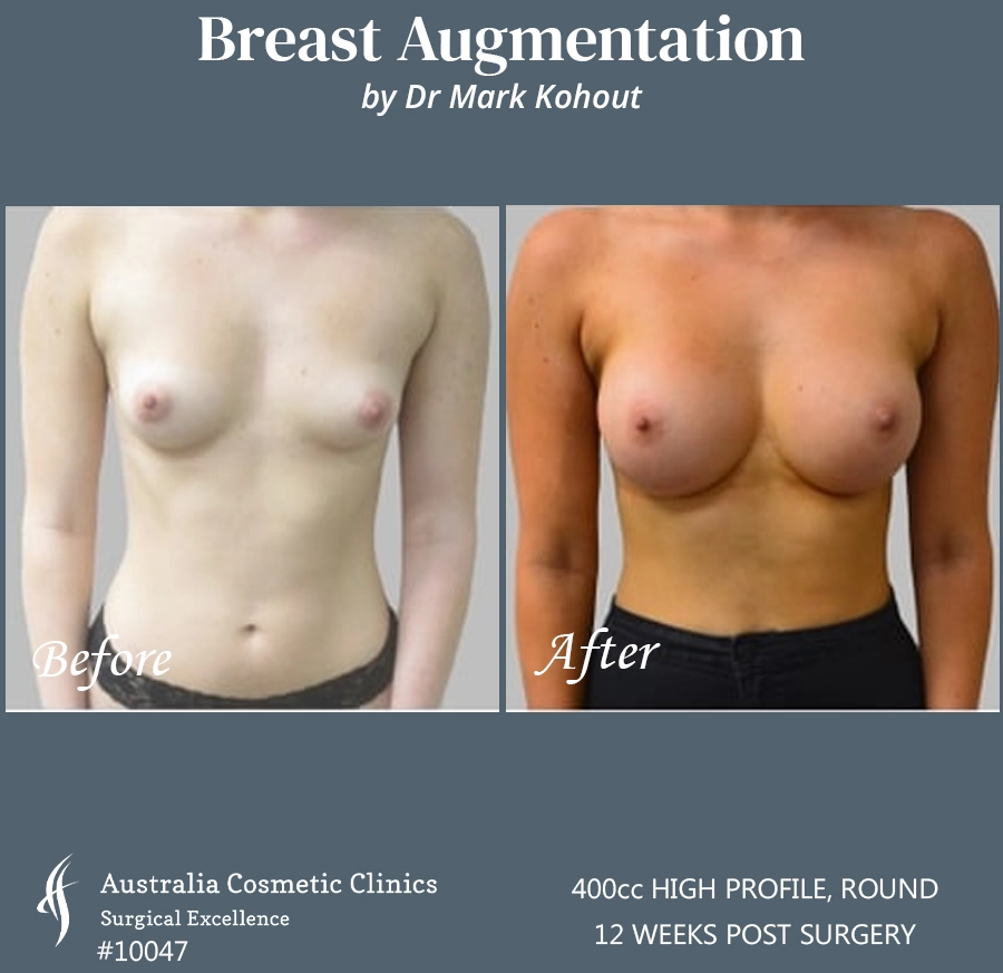 Breast Augmentation Patient 10047 FRONT