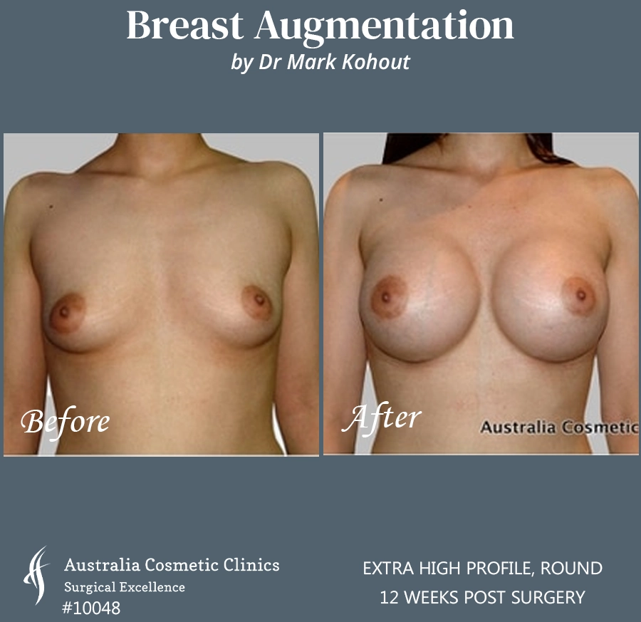 Breast Augmentation Patient 10048 FRONT