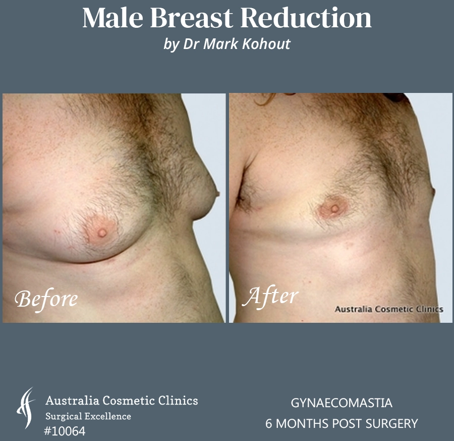 Gynaecomastia Patient 10064 45