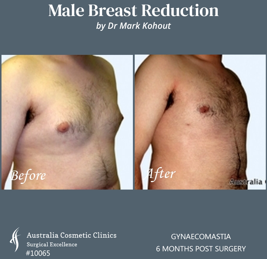 Gynaecomastia Patient 10065 45