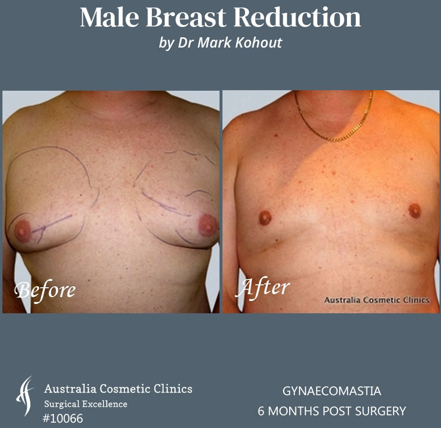 Gynaecomastia Patient 10066 FRONT