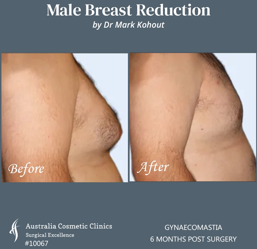 Gynaecomastia Patient 10067 SIDE