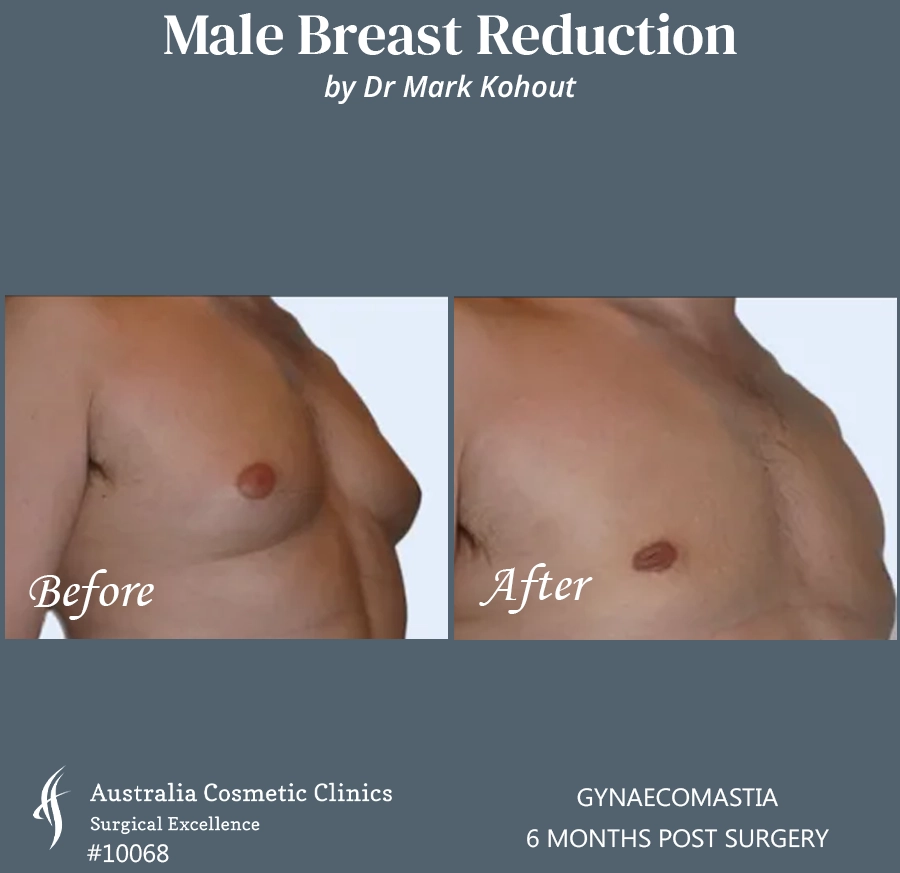 Gynaecomastia Patient 10068 45