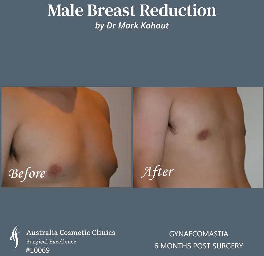 Gynaecomastia Patient 10069 45