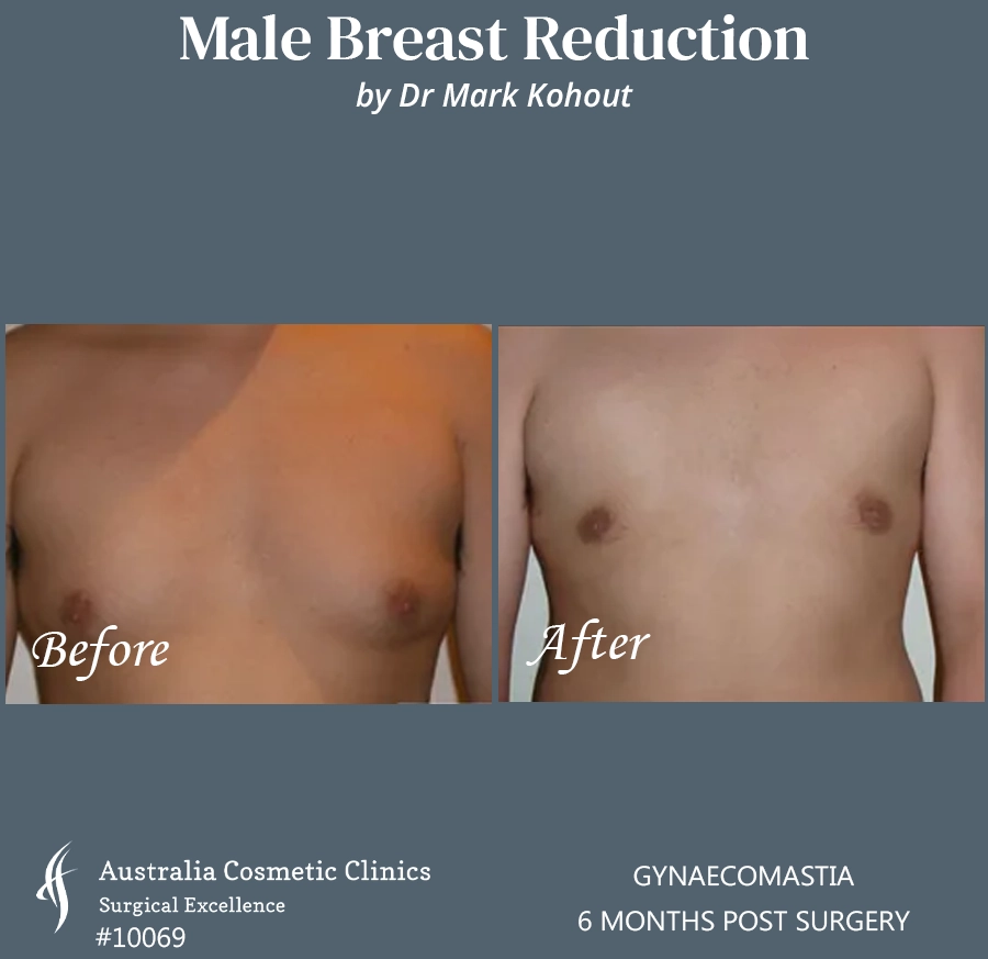 Gynaecomastia Patient 10069 FRONT