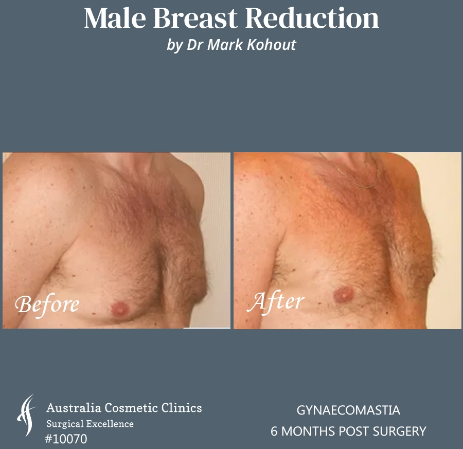 Gynaecomastia Patient 10070 45