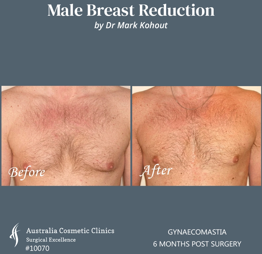 Gynaecomastia Patient 10070 FRONT