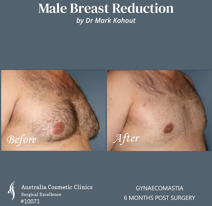Gynaecomastia Patient 10071 45