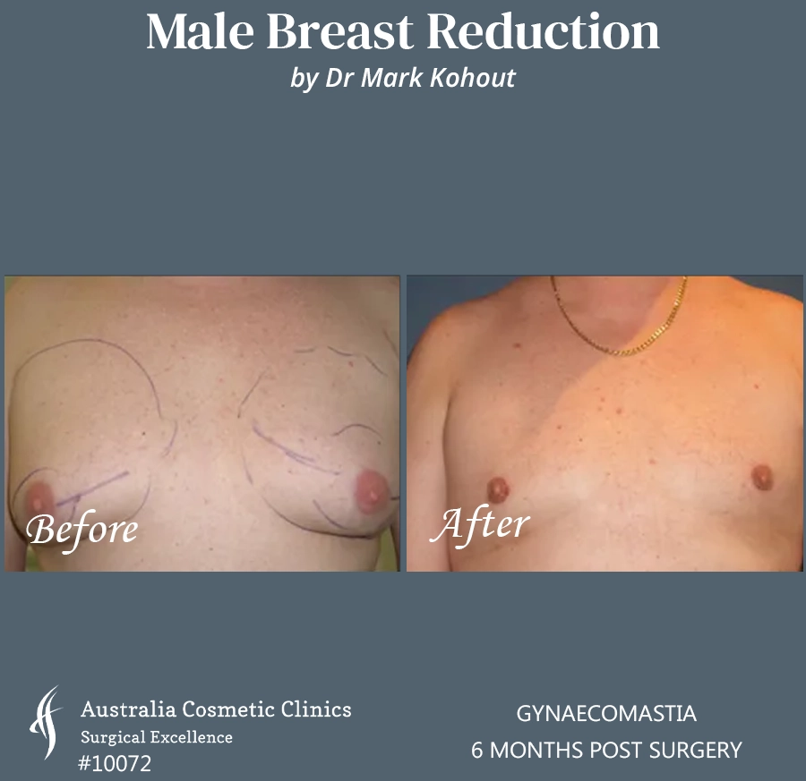 Gynaecomastia Patient 10072 FRONT