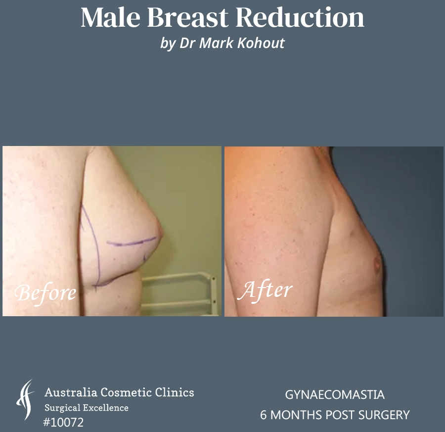 Gynaecomastia Patient 10072 SIDE