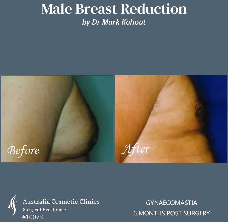 Gynaecomastia Patient 10073 SIDE