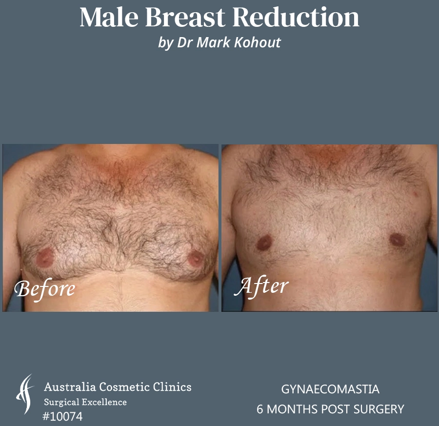 Gynaecomastia Patient 10074 FRONT