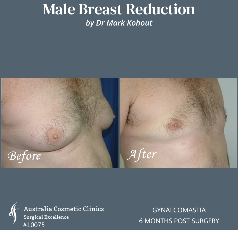 Gynaecomastia Patient 10075 45