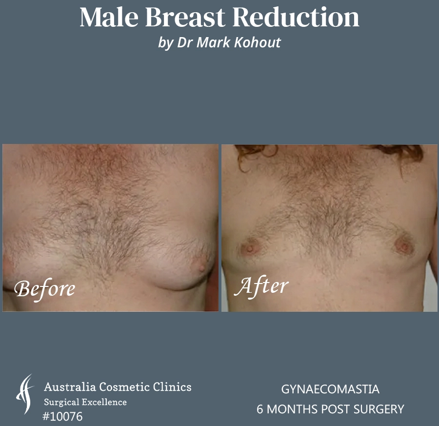 Gynaecomastia Patient 10076 FRONT