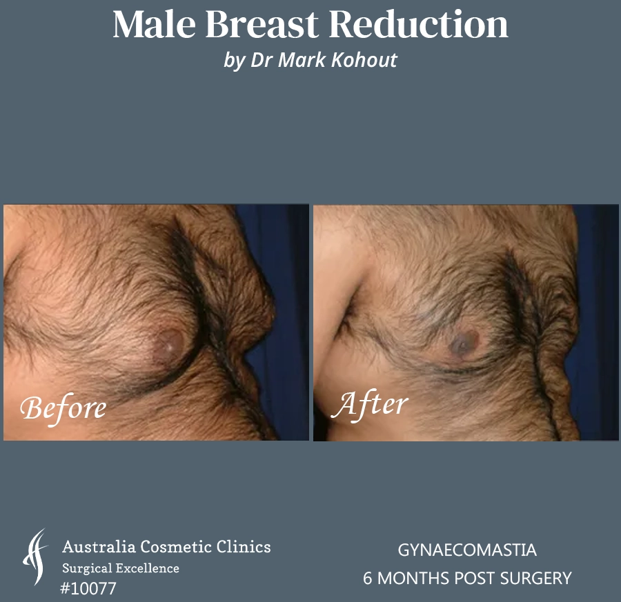 Gynaecomastia Patient 10077 45