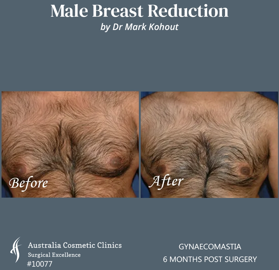 Gynaecomastia Patient 10077 FRONT