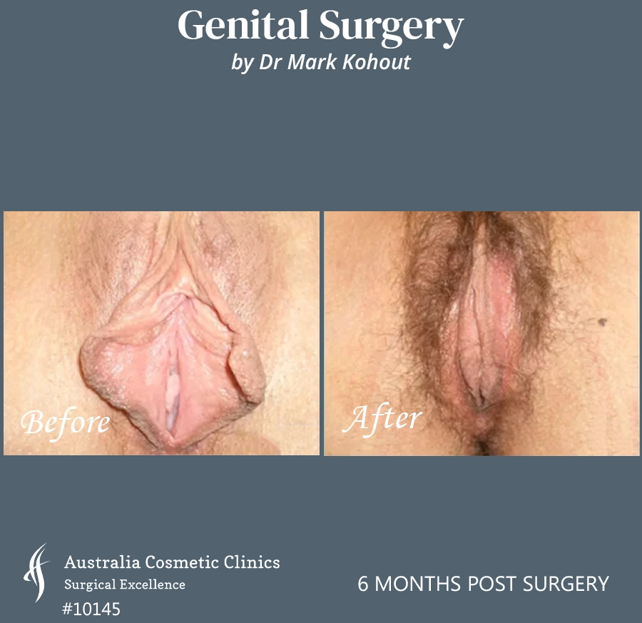 Labiaplasty Patient 10145 Front