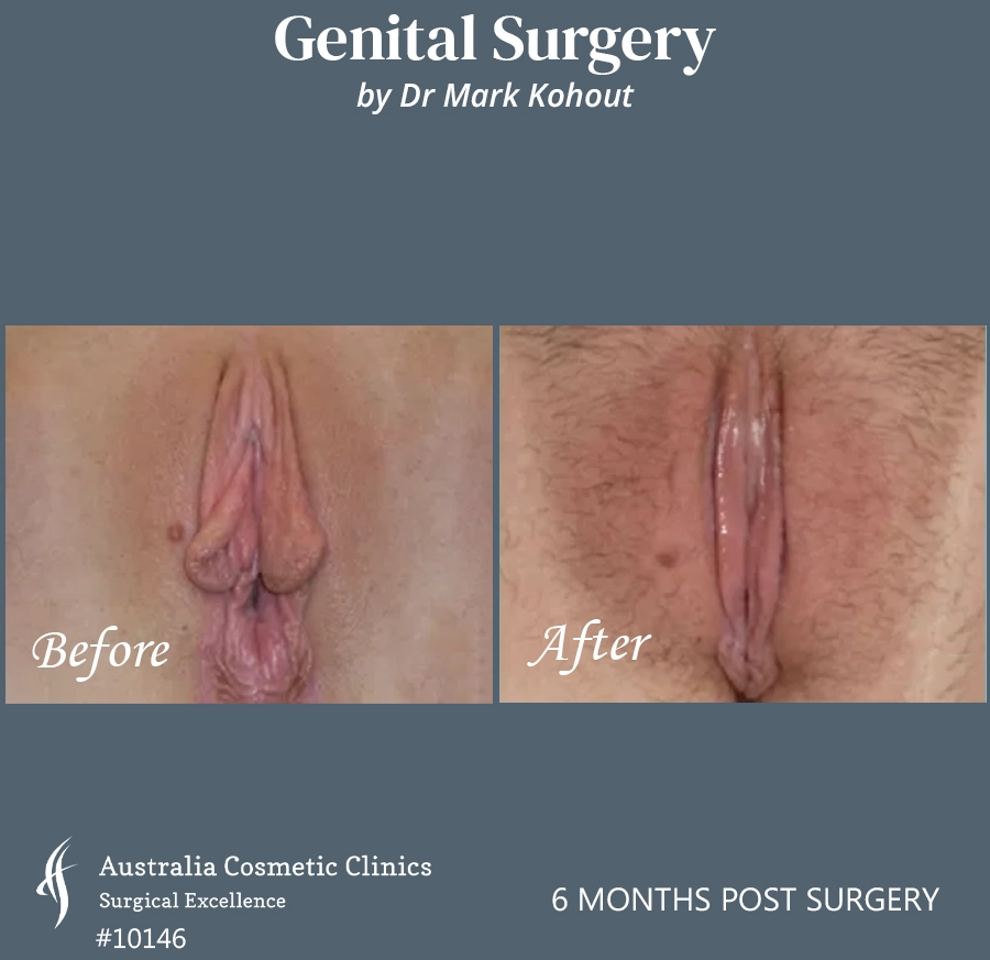 Labiaplasty Patient 10146 Front