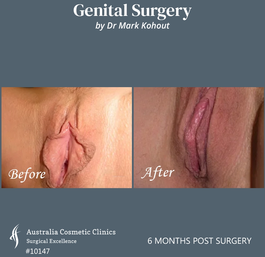 Labiaplasty Patient 10147 Front