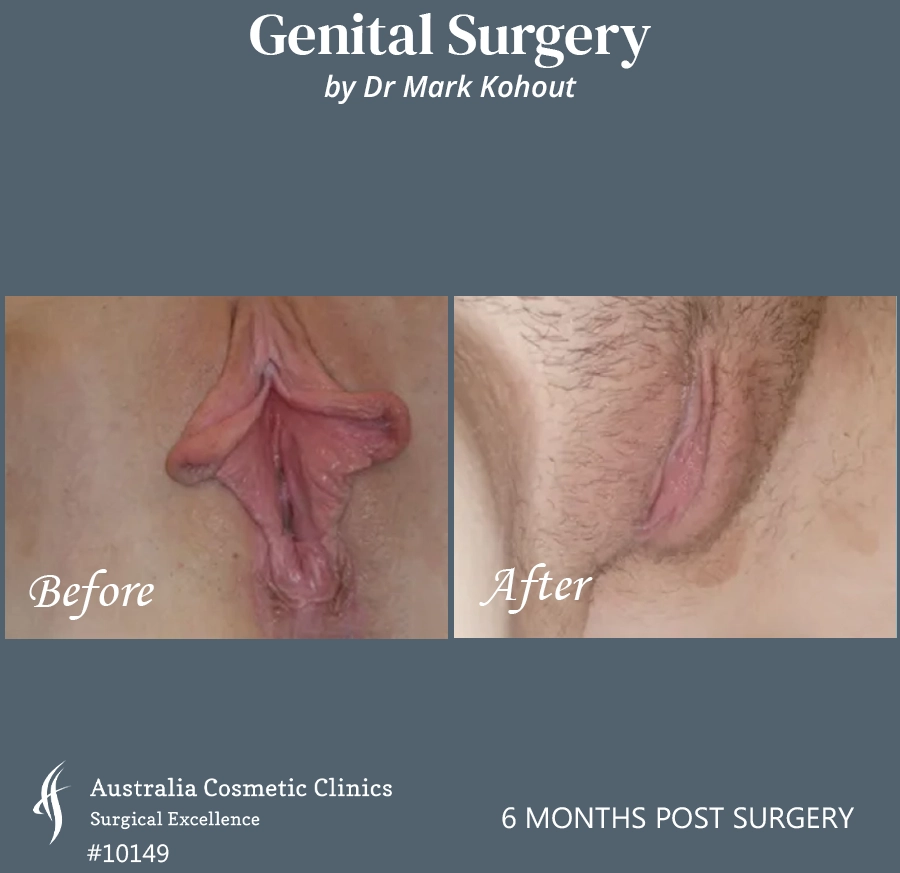 Labiaplasty Patient 10149 Front