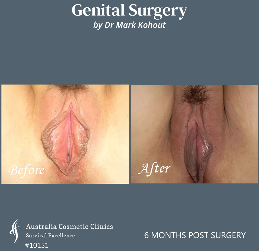 Labiaplasty Patient 10151 Front